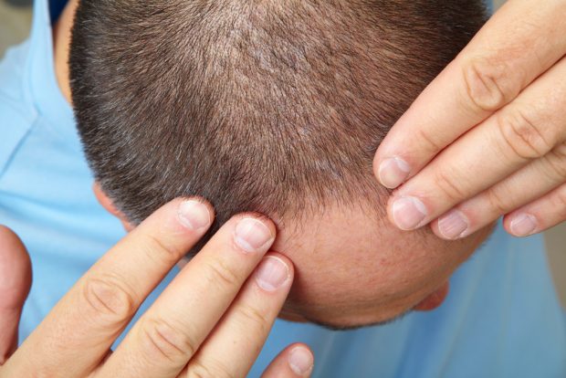 Tips for Handling the Mental Impact of Hair Loss for Men
