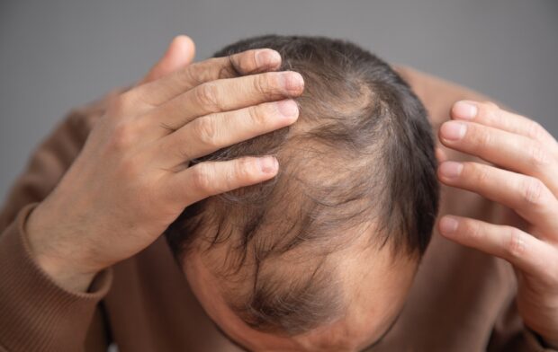 The Rise of Non-Surgical Hair Replacement Systems in 2025