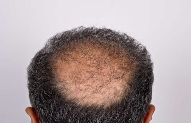 Men’s Hair Replacement: Restoring Confidence Without the Downtime