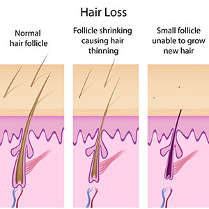 Non-Surgical Hair Replacement